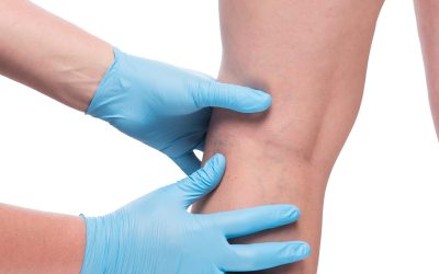 Relief from Varicose Veins Awaits with a Trusted Vein Specialist in Baltimore, MD