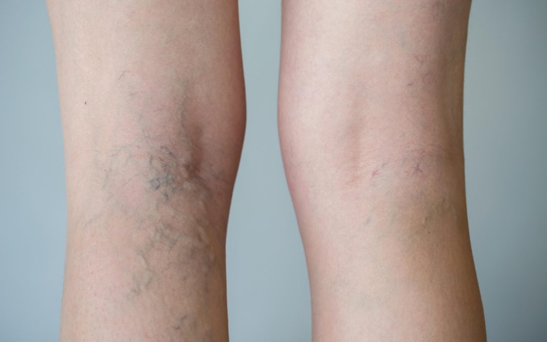 Effective Ways to Achieve Smooth Legs with Spider Veins Treatment in Warrenton, VA