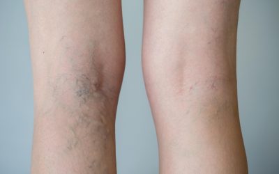 Effective Ways to Achieve Smooth Legs with Spider Veins Treatment in Warrenton, VA