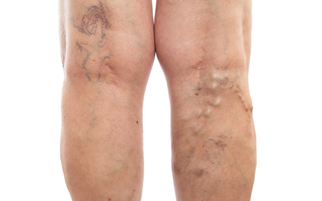 Effective ways to manage Deep Vein Thrombosis in Petersburg, VA for better health outcomes