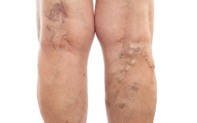Effective ways to manage Deep Vein Thrombosis in Petersburg, VA for better health outcomes