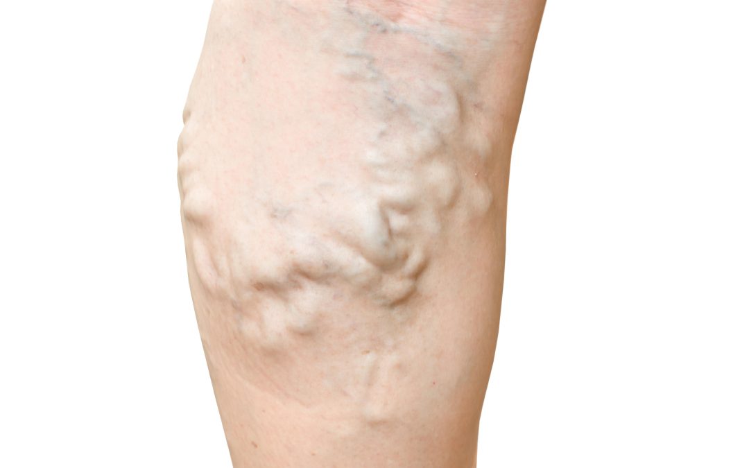 Effective Ways to Prevent Deep Vein Thrombosis in Virginia Beach, VA Residents