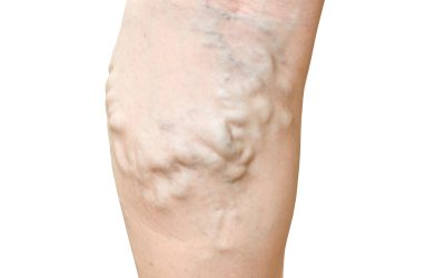 Effective Ways to Prevent Deep Vein Thrombosis in Virginia Beach, VA Residents