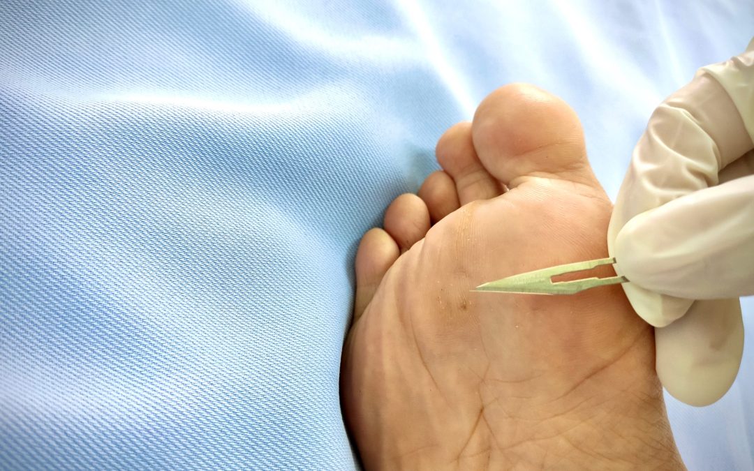 Relieve Pain and Walk Easily Thanks to Bunion Treatment Fulshear, TX Options