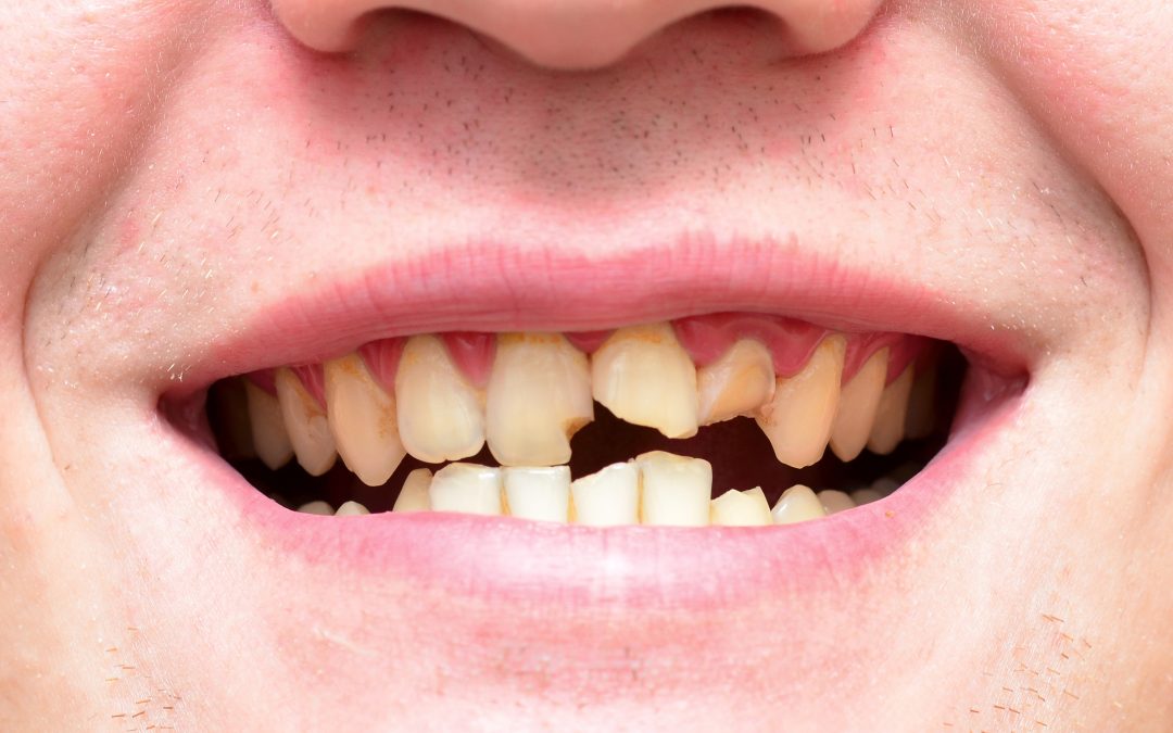 Restore Your Smile Confidence With Dental Crown Richland, WA for Lasting Strength